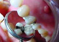 一般歯科/虫歯治療